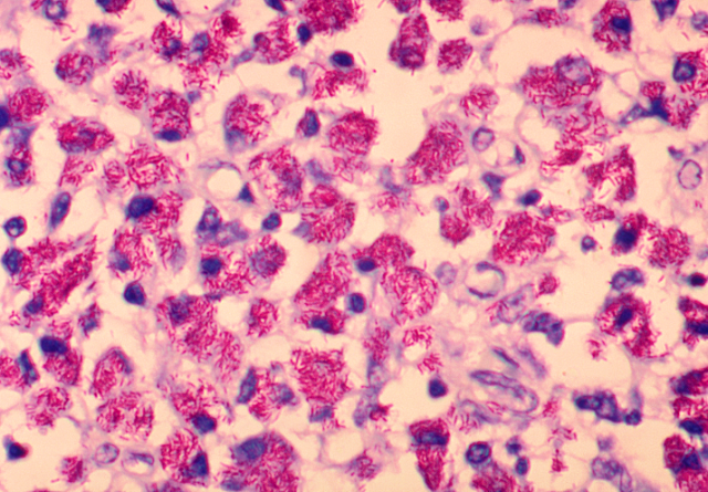 Mycobacterium avium