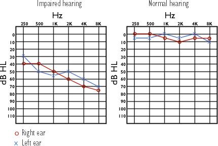 hallásveszteség